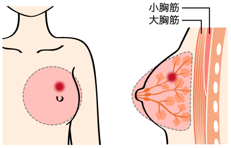 図　胸筋温存乳房切除術