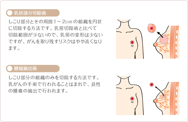 乳房温存手術の種類　[乳房部分切除術]しこり部分とその周囲1～2cmの組織を円状に切除する方法です。乳房切除術と比べて切除範囲が少ないので、乳房の変形は少ないですが、がんを取り残すリスクはやや高くなります。　[腫瘤摘出術]しこり部分の組織のみを切除する方法です。乳がんの手術で行われることはまれで、良性の腫瘍の摘出で行われます。