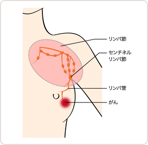 センチネルリンパ節