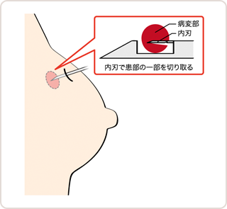 図2　針生検