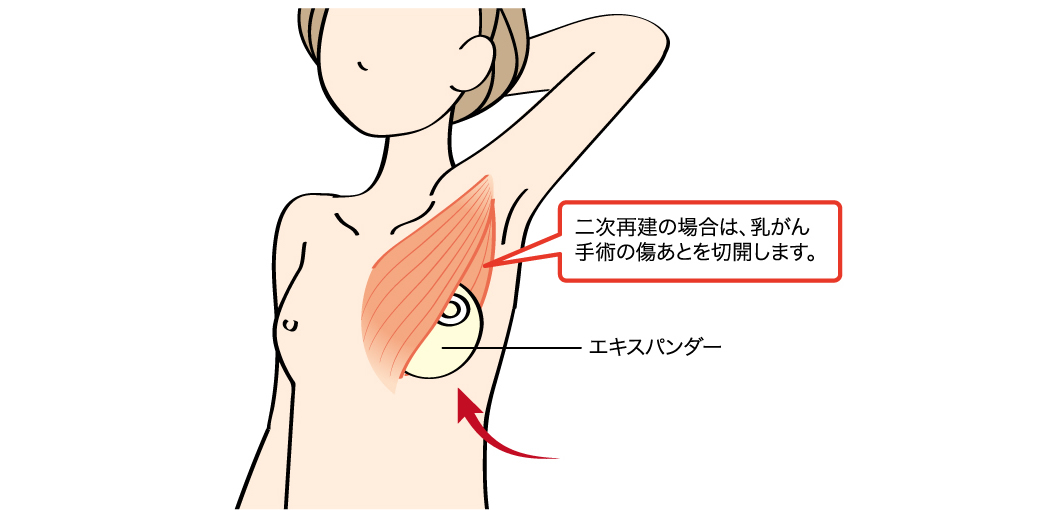 ①乳がんの手術後に、エキスパンダーを挿入する。