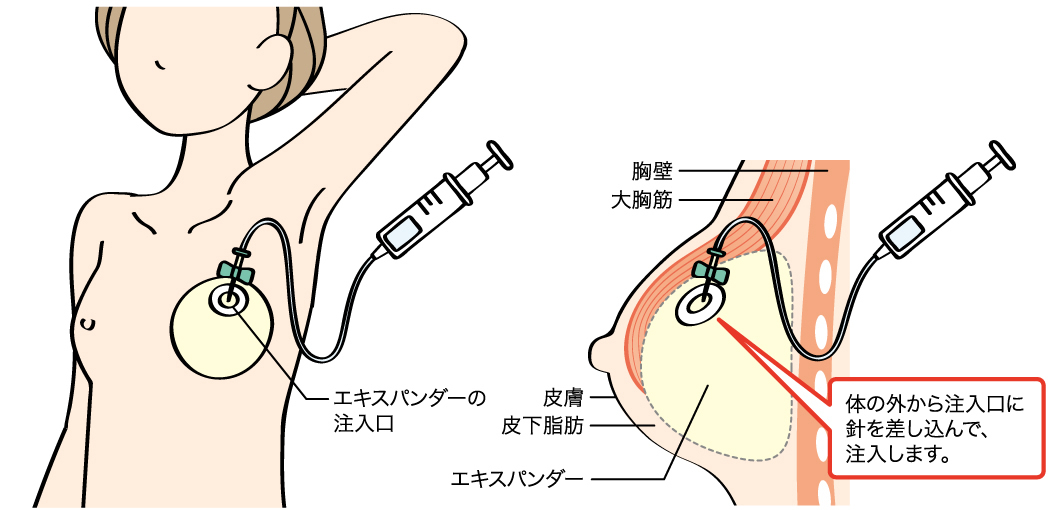 ②エキスパンダーに生理食塩水を注入する。約2週間ごとに1～6ヵ月かけて追加注入する。