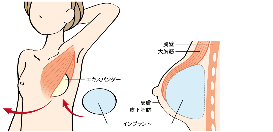 ③皮膚とその周辺組織が十分に伸びたら、同じ傷あとを切開し、エキスパンダーとインプラントを入れ替える。