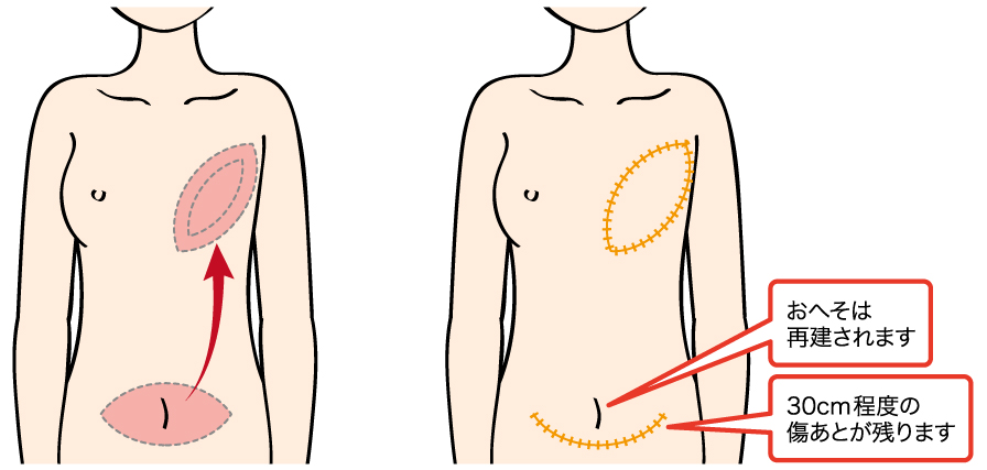 図 お腹の組織による乳房再建術（腹直筋皮弁法）