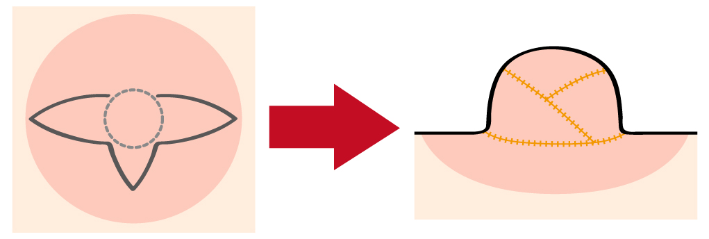 図 皮膚を持ち上げて形成する方法