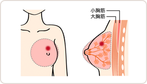 胸筋温存乳房切除術